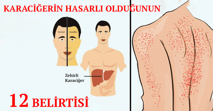 Karaciğerin Çalışmadığına Gösteren 12 Belirti - 2