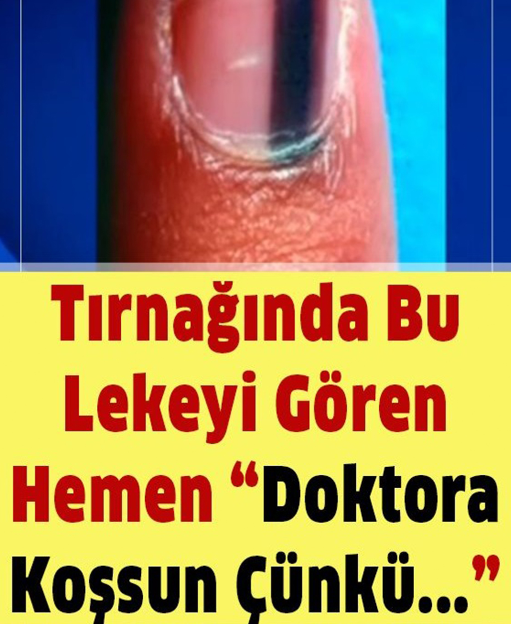 Tırnağınızın Altında Böyle Bir İşaret Görürseniz Hemen Hekime Gidin - 1